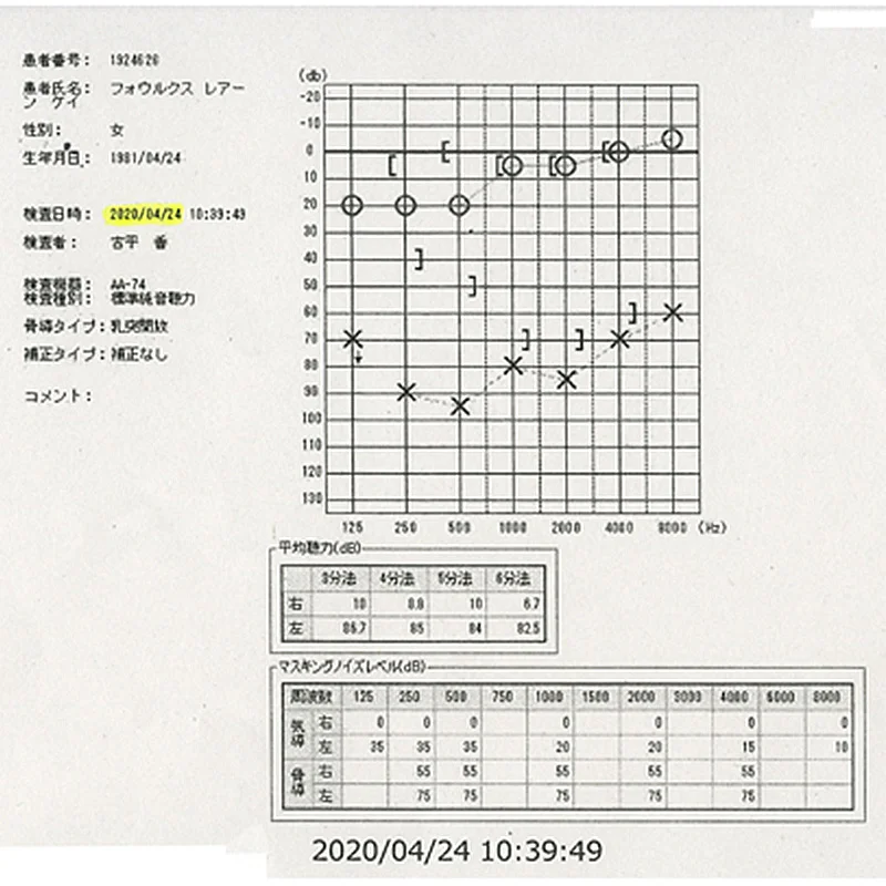 ステロイド依存性難聴｜突発性難聴でステロイドの治療をやめてから悪化したオージオグラム