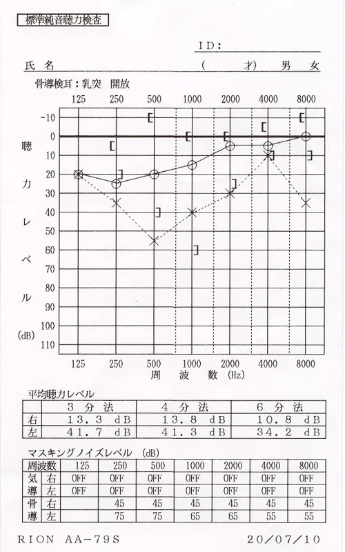 突発性難聴でステロイド治療を終了後悪化したステロイド依存型難聴が鍼治療で改善したオージオグラム