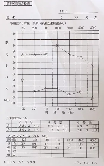 突発性難聴｜ステロイドで変化がなかった突発性難聴のオージオグラム