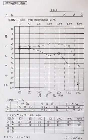 突発性難聴｜ステロイドで変化のなかった突発性難聴が鍼治療で回復したオージオグラム