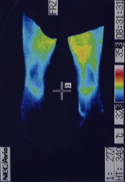 腰椎分離すべり症の手術後に悪化した腰痛のサーモ画像（治療前）