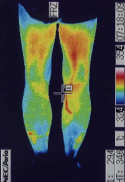 腰椎分離すべり症の手術後に悪化した腰痛のサーモ画像（治療後）