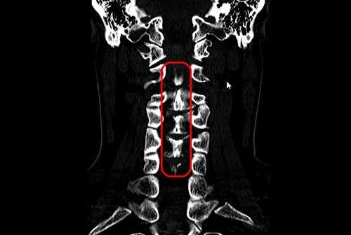 後縦靭帯骨化症　首のCT